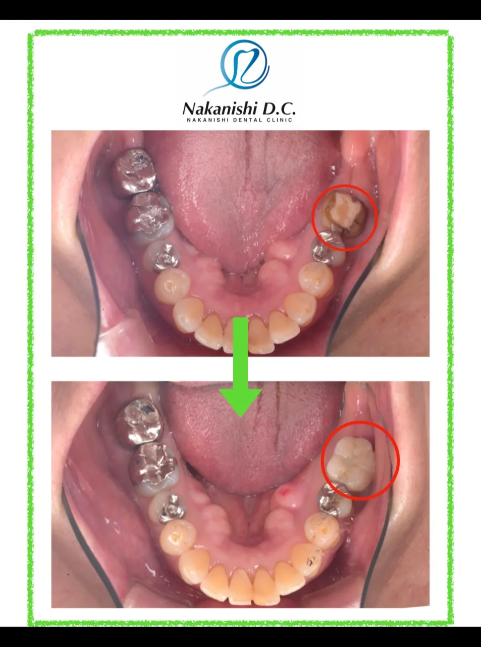 🦷 抜歯即時埋入インプラント
